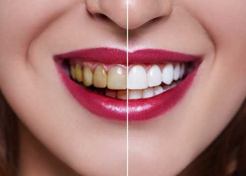Teeth-Whitening